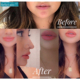 Lip Fillers Bellatudo Skin and Wellness