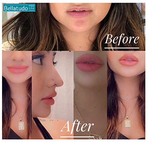 Lip Fillers Bellatudo Skin and Wellness