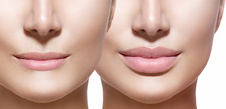 Dermal Fillers