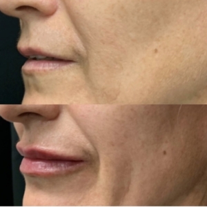 Lip filler to create taller youthful lips with Restylane Kysse, one syringe