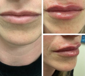 Lip filler to create elegant, naturally youthful looking lips, with one syringe Restylane Kysse