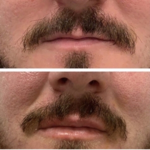 Lip filler for men to look more youthful