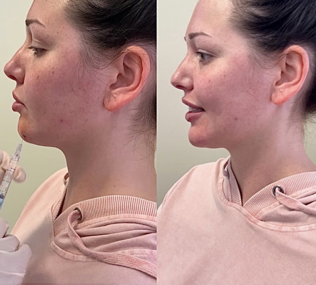 Chin filler to improve chin projection and jawline definition