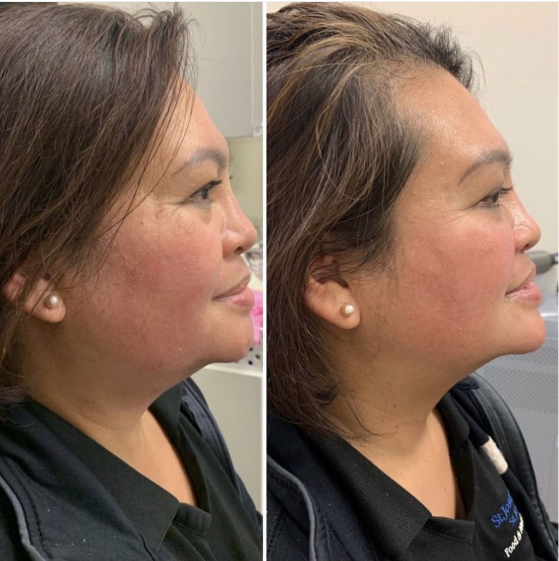 Chin filler to improve chin projection and jawline definition, with Restylane Defyne one syringe