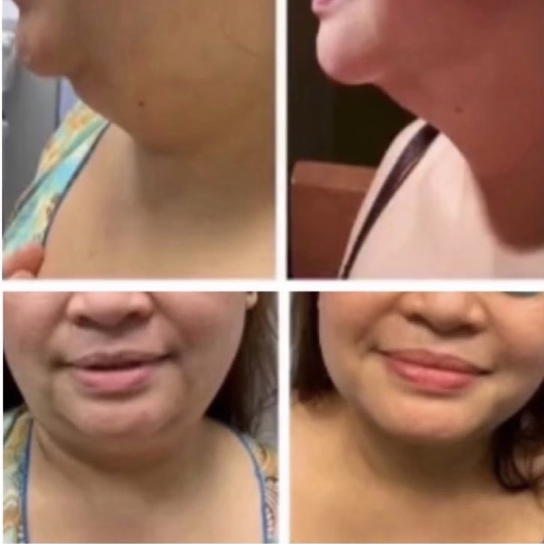 Agnes (Radiofrequency plus Microneedling) treatment for under chin and jowl fat reduction