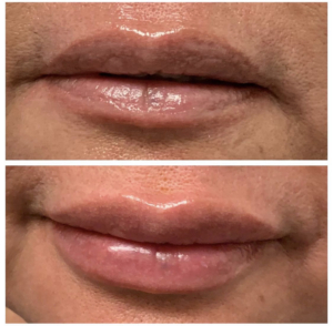 Lip sculpting and balancing with Restylane one syringe