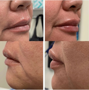 Lip sculpting and balancing with Restylane one syringe