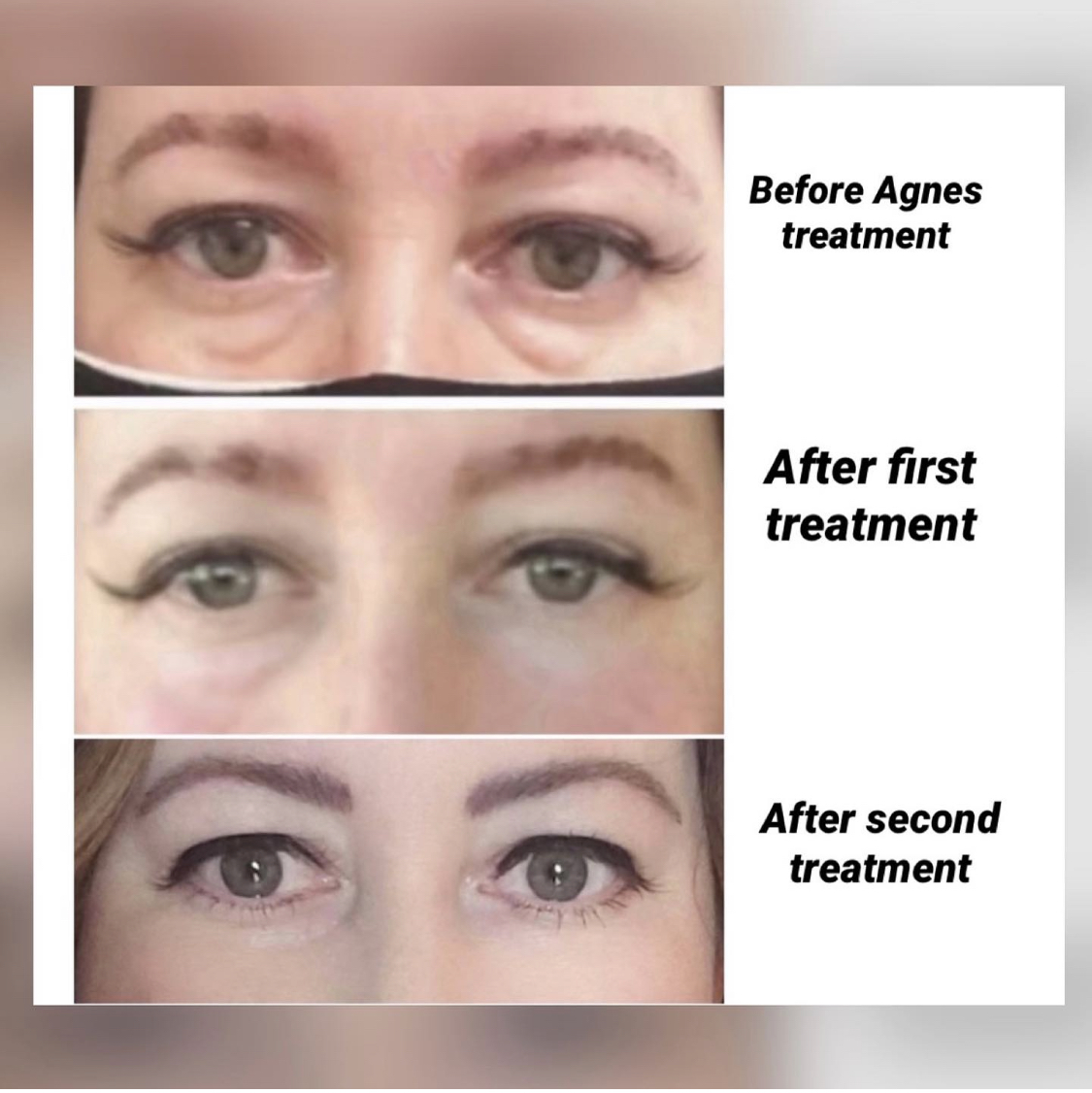 Agnes (Radiofrequency plus Microneedling) treatment for under eye bags