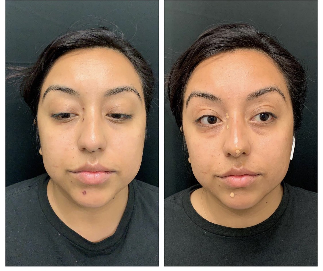Nose filler with Restylane