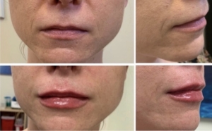 lip filler at bellatudo skincarw and wellness