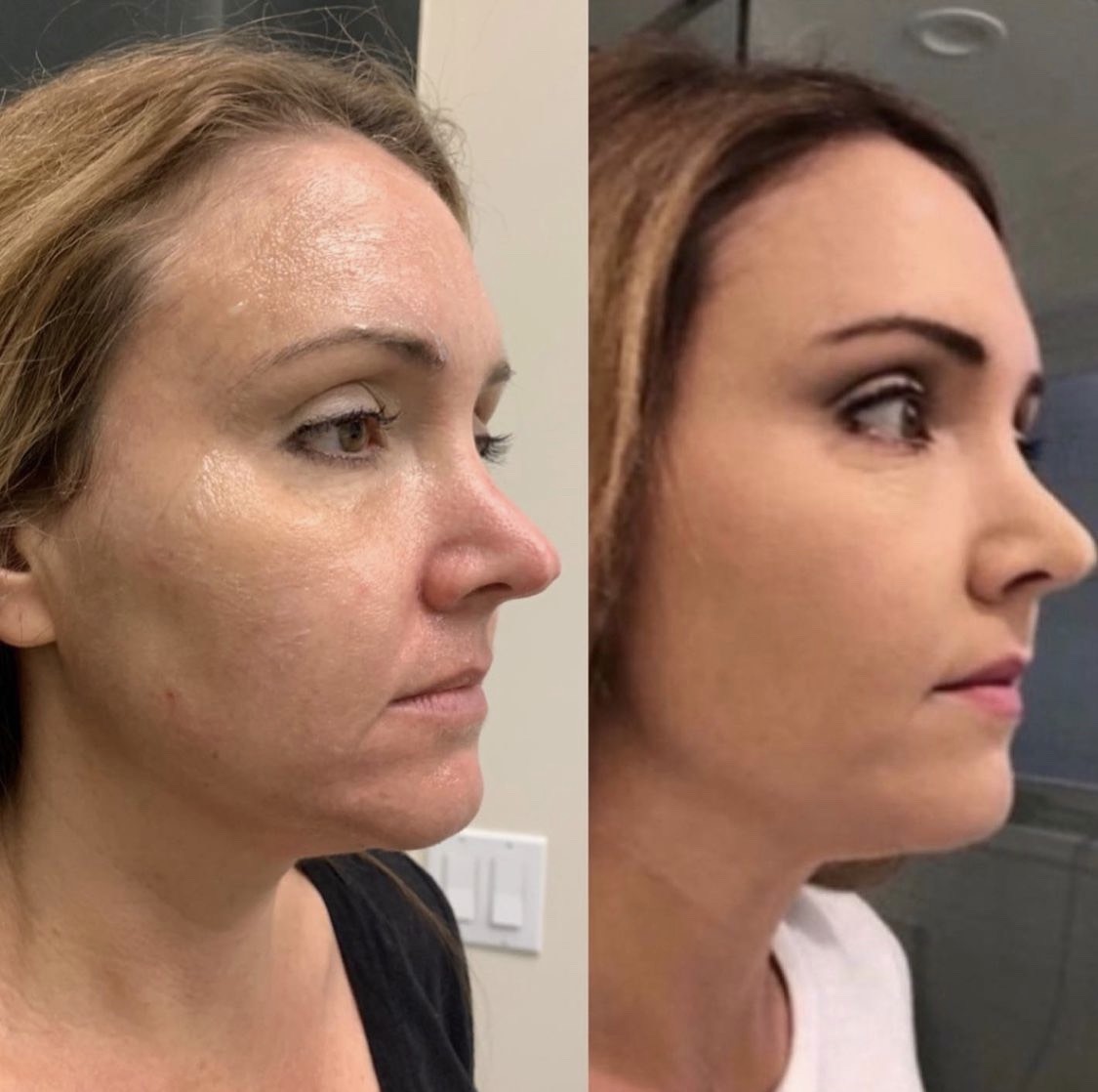 Scarlet (Radio-frequency plus Micro-needling) treatment for face lifting and tightening
