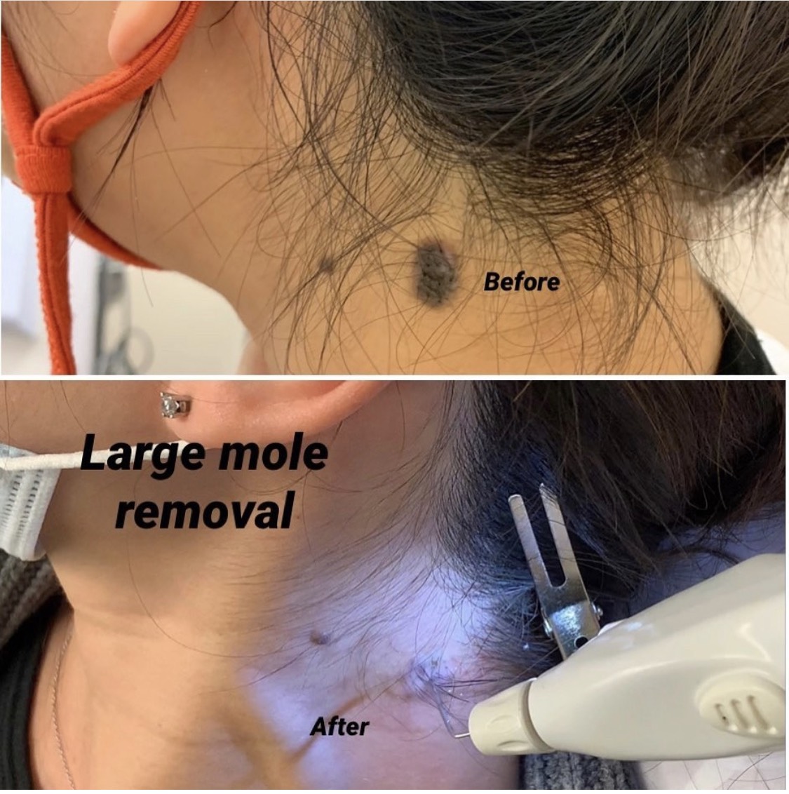 Thus large mole needed both laser and Plexr Plasma to remove. 