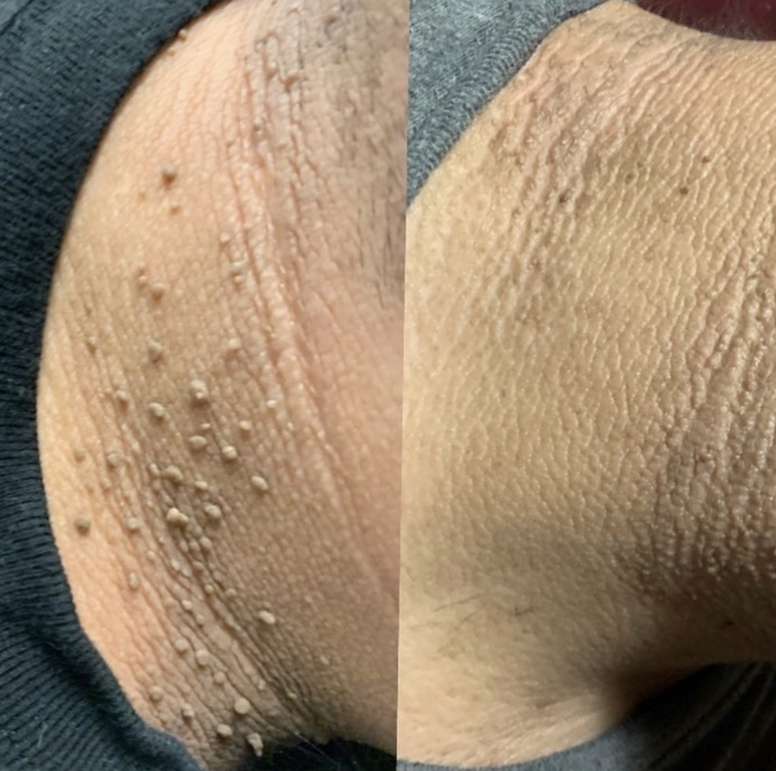 Skin tag removal on pigmented skin is best done with Plexr Plasma