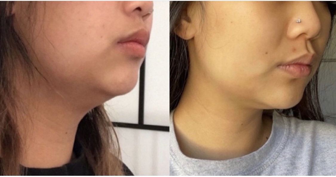 Kybella injection for chin fat pad reduction to improve the chin and jawline profile, after 2 vials 