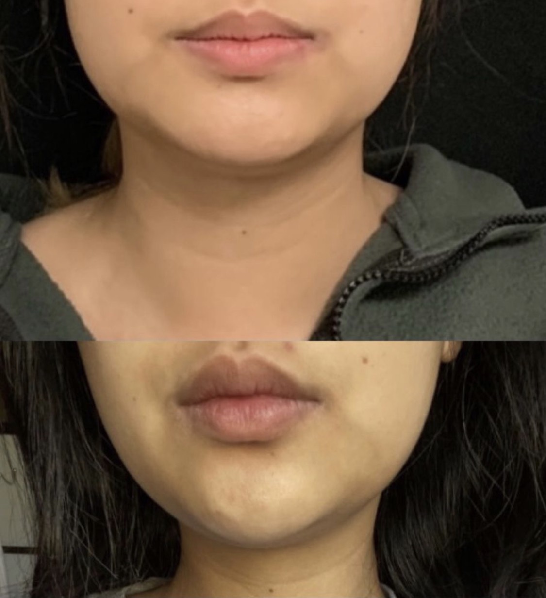 Kybella injection for chin fat pad reduction to improve the chin and jawline profile, after 2 vials 