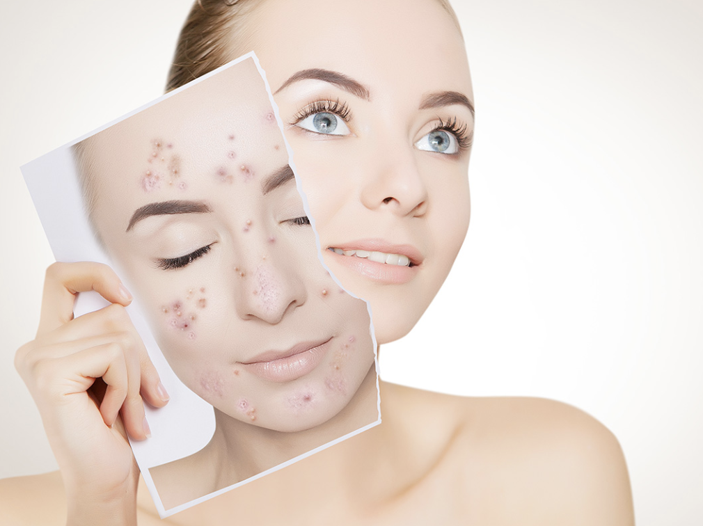 Transformative acne treatment at Bellatudo Skin and Wellness med spa: Clear, radiant skin awaits!