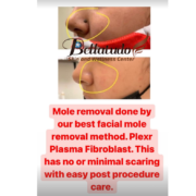 Plexr Plasma Pen Mole Removal at Bellatudo Skin and Wellness Center