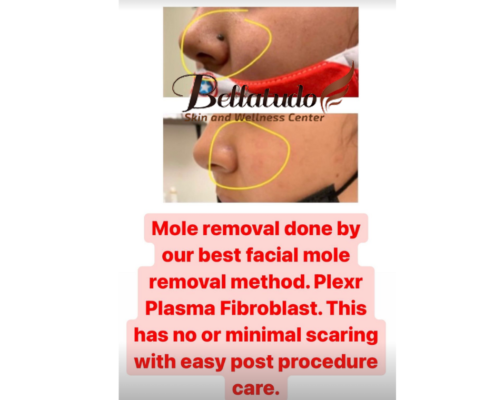 Plexr Plasma Pen Mole Removal at Bellatudo Skin and Wellness Center