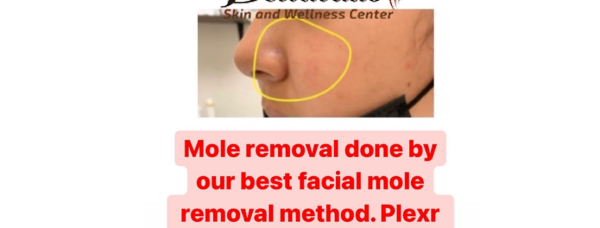 Plexr Plasma Pen Mole Removal at Bellatudo Skin and Wellness Center